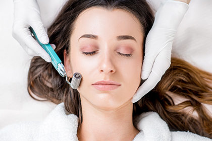 Microneedling for Acne Scarring